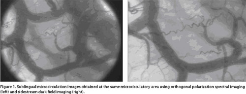 clinical microcirculation,Side stream dark field imaging (SDF),sepsis,blood poisoning,pyemia,pyohemia