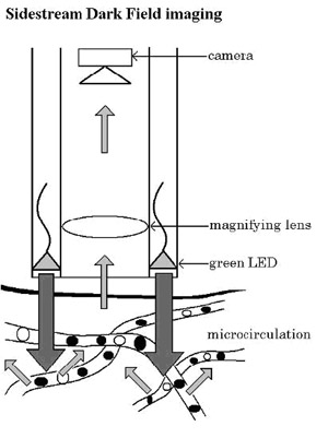 SDF imaging device,sepsis,blood poisoning,pyemia,pyohemia,Sidestream Dark Field(SDF)