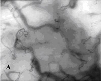 SDF imaging device,sepsis,blood poisoning,pyemia,pyohemia,Sidestream Dark Field(SDF)