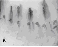 SDF imaging device,sepsis,blood poisoning,pyemia,pyohemia,Sidestream Dark Field(SDF)