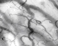 SDF imaging device,sepsis,blood poisoning,pyemia,pyohemia,Sidestream Dark Field(SDF)