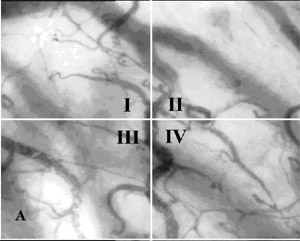 SDF imaging device,sepsis,blood poisoning,pyemia,pyohemia,Sidestream Dark Field(SDF)