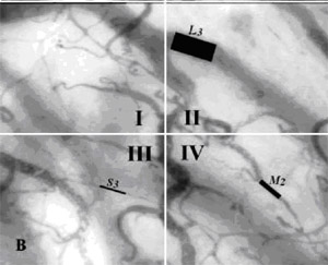 SDF imaging device,sepsis,blood poisoning,pyemia,pyohemia,Sidestream Dark Field(SDF)