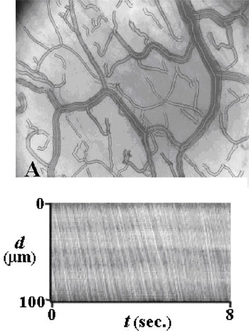 SDF imaging device,sepsis,blood poisoning,pyemia,pyohemia,Sidestream Dark Field(SDF)